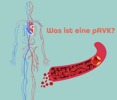 Was ist eine periphere Arterielle Verschlusskrankheit (pAVK)?