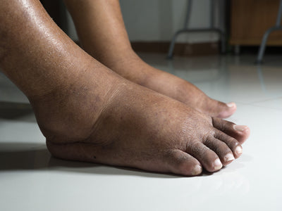 Charcot-Fuß - Definition, Ursache und Therapie