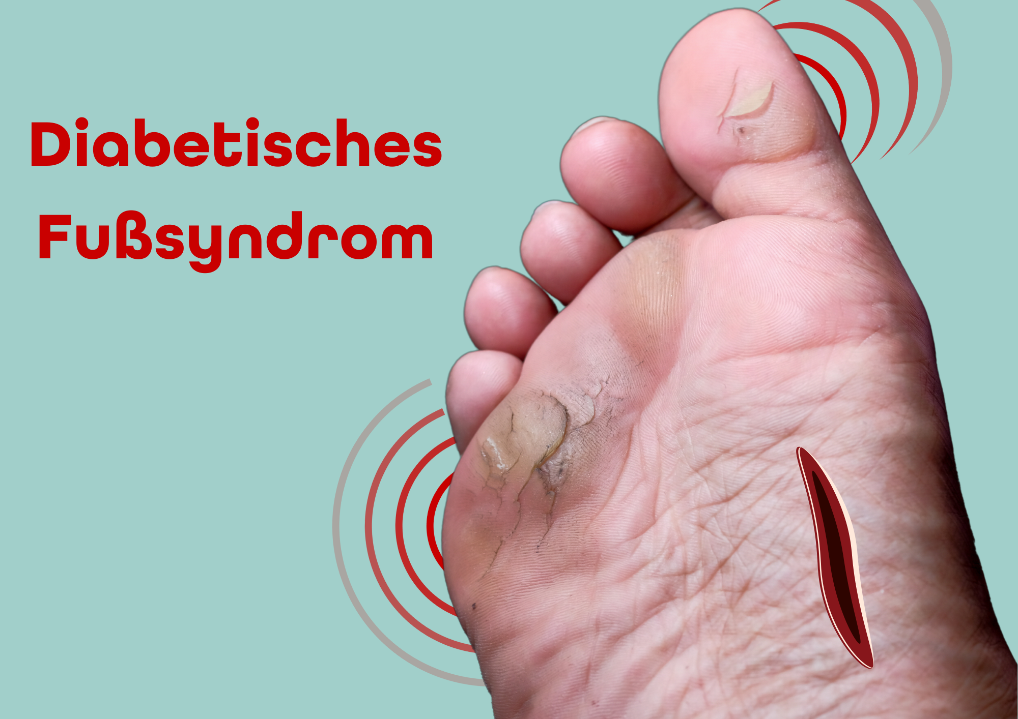 What is diabetic foot syndrome – osentec