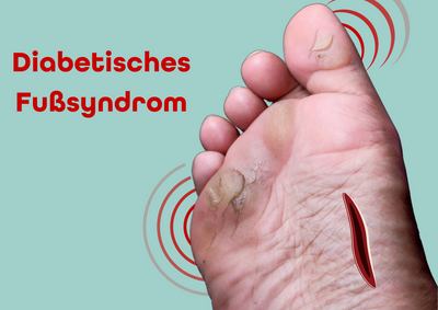 Was ist das diabetische Fußsyndrom?